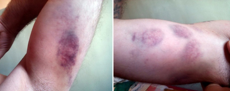 Анатолий Пламадяла: «В СИЗО врач сказал: «Это покраснение, зафиксировать не могу, синяков явных нет»